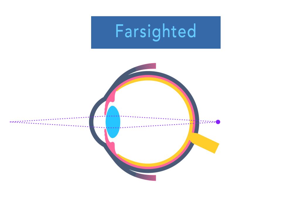 diagram of hyperopia, where the shape of your eye causes light to focus too far behind the retina. 