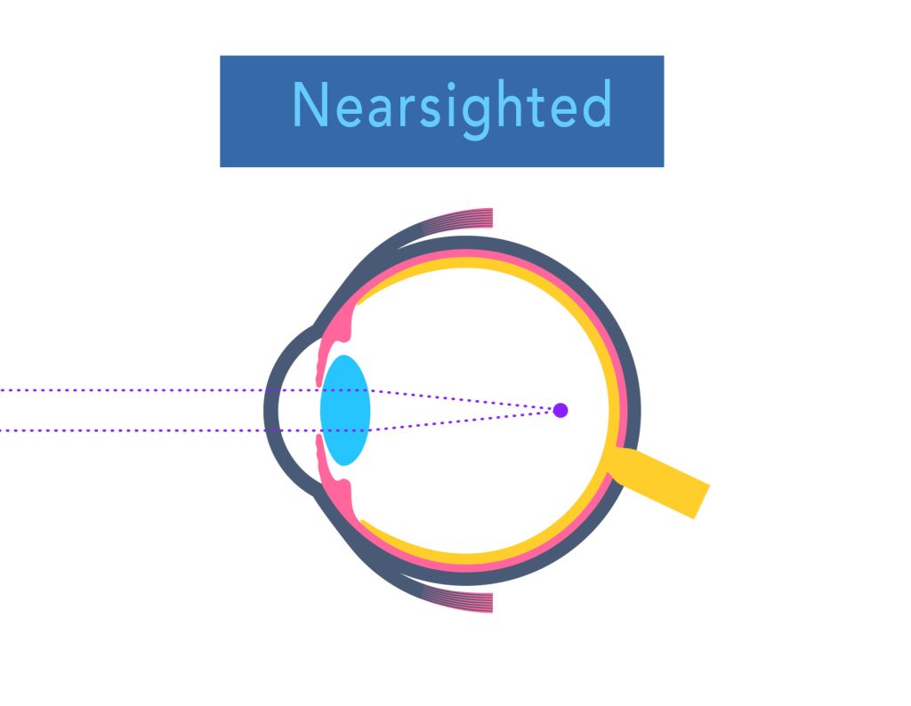 eyeball diagram showing nearsightedness