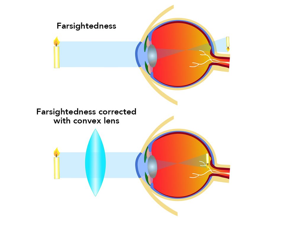 diagram showing how glasses correct farsightedness with a convex lens